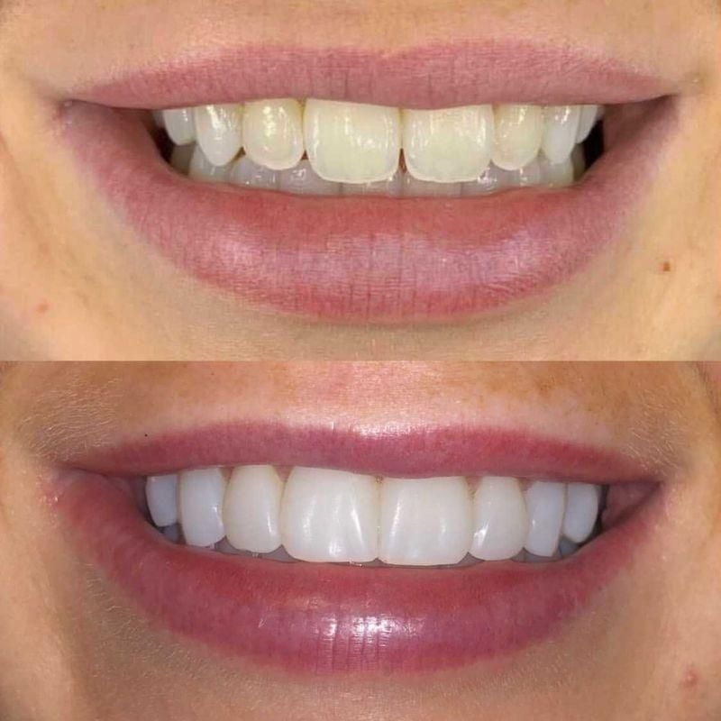 Before and after treatment at Queens Drive Dental in Glasgow 