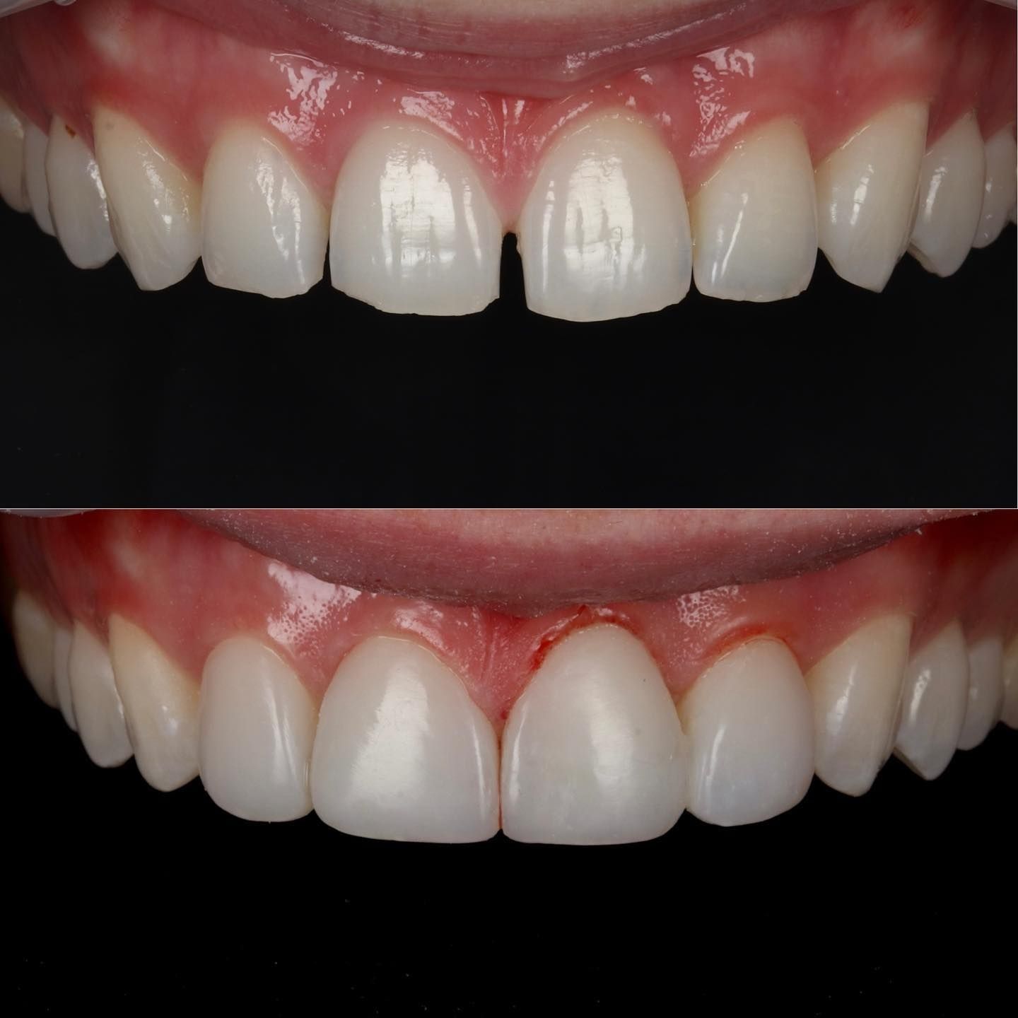 Before & After Composite Treatments