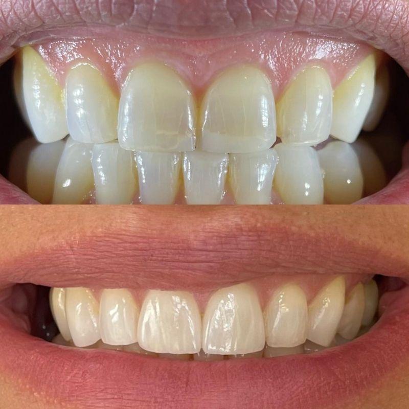 Queens Drive Dental Practice | Smile Makeovers Glasgow Before and after treatment at Queens Drive Dental