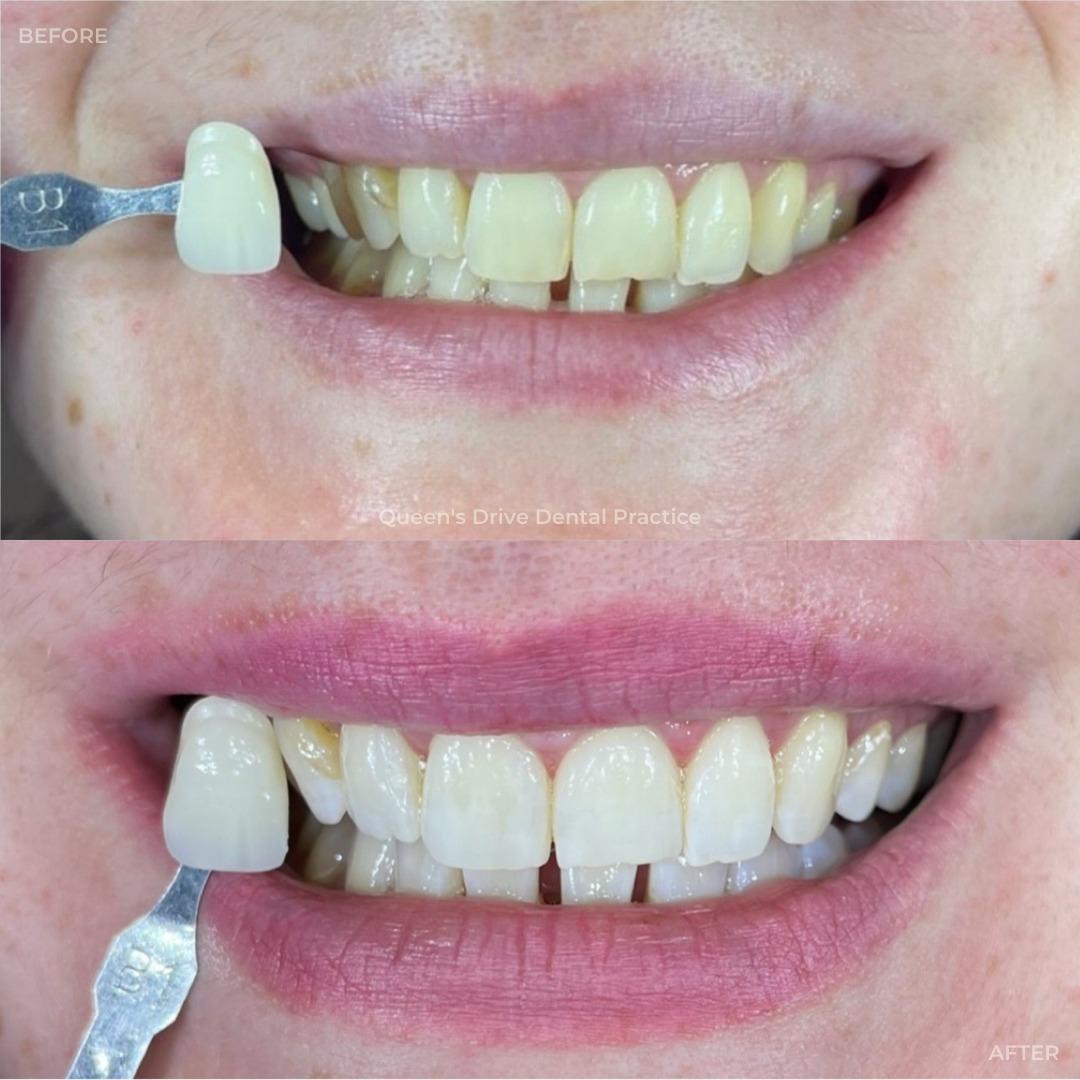 Get a brighter, whiter smile with Teeth Whitening