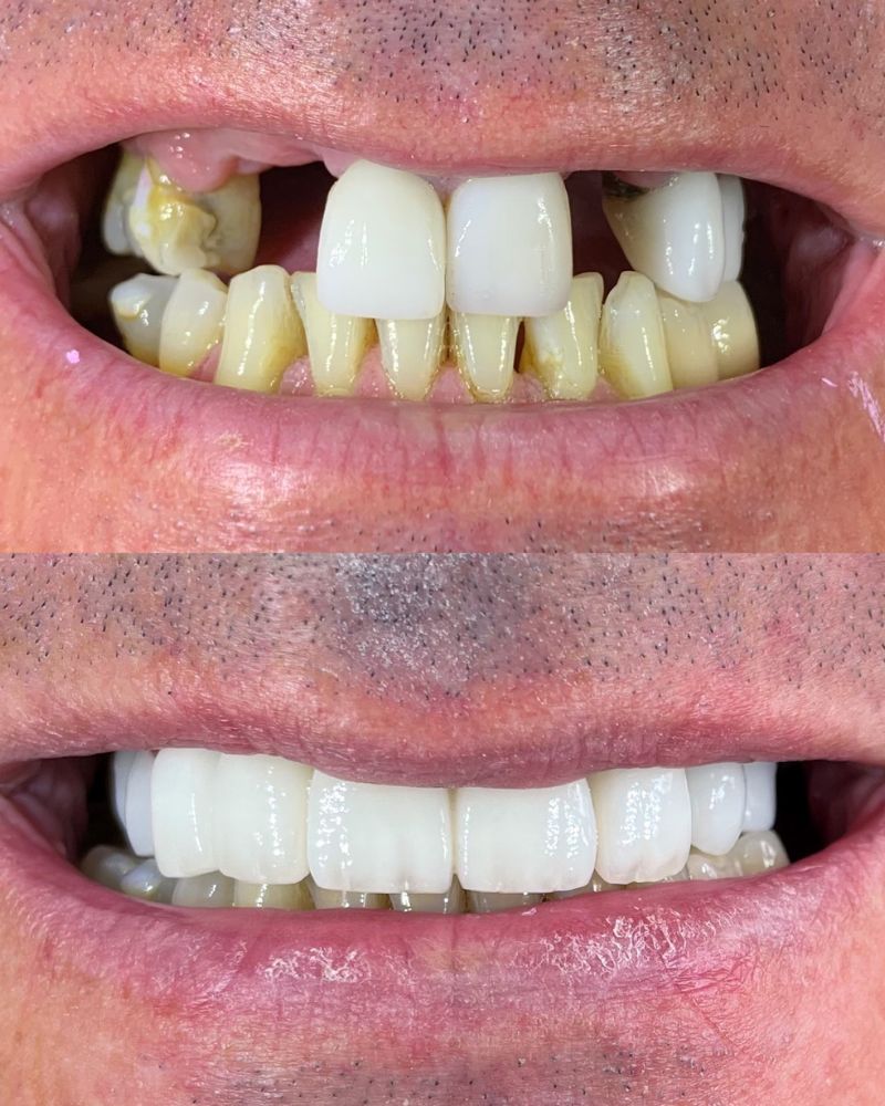 Queens Drive Dental Practice | John Paul Delaney Before & after treatment with John Paul