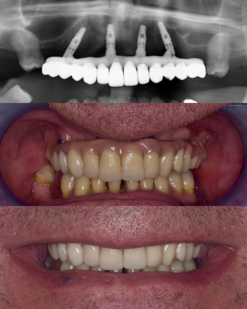 Queens Drive Dental Practice | John Paul Delaney Before & after treatment with John Paul