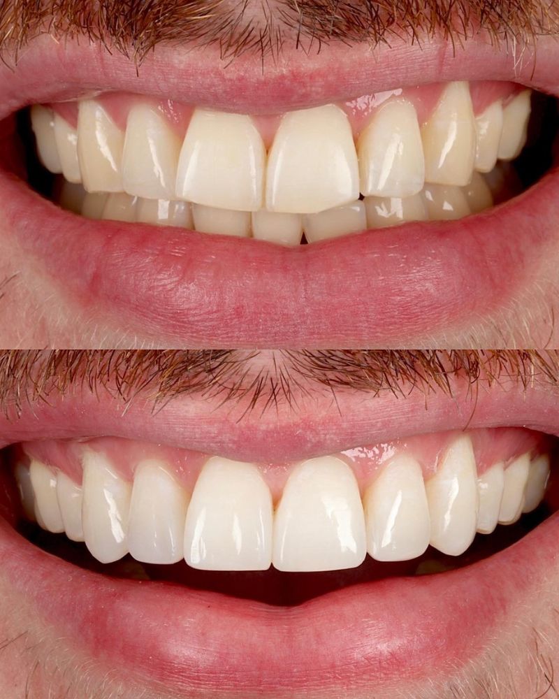 Queens Drive Dental Practice | Anthony O'keefe Before & after treatment with Anthony