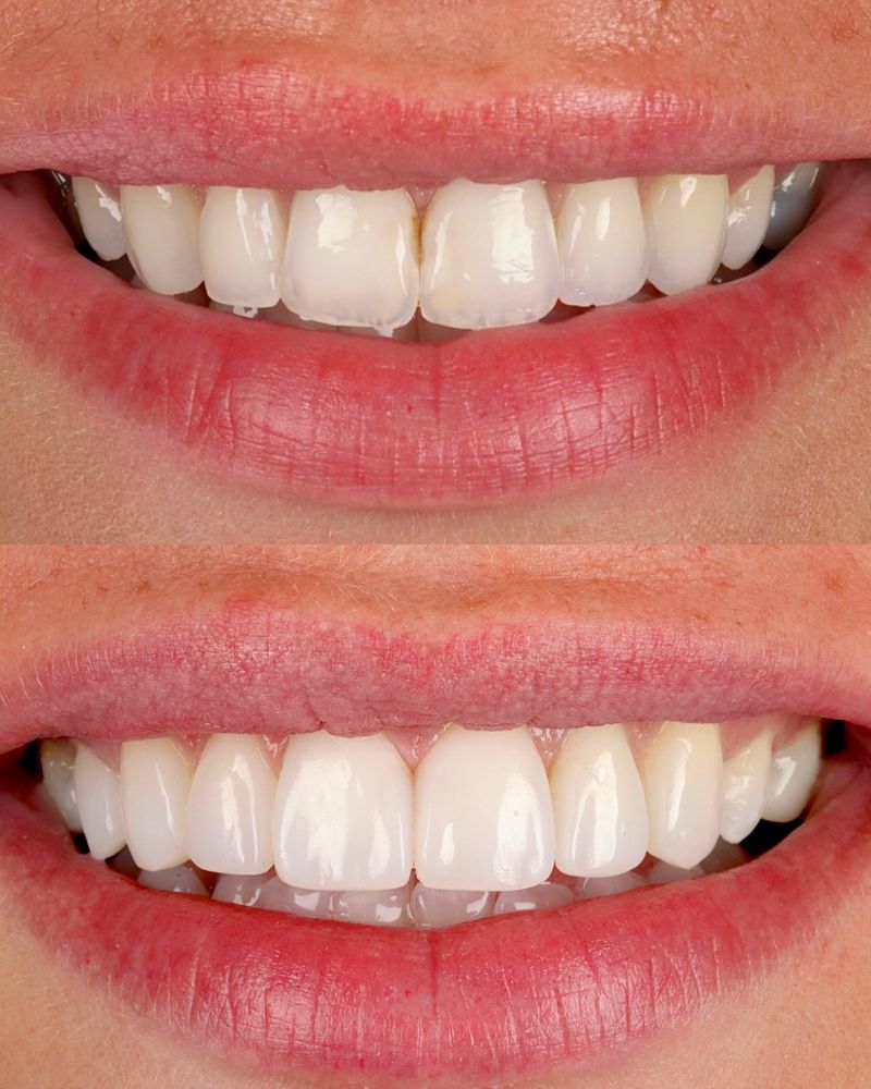Queens Drive Dental Practice | Anthony O'keefe Before & after treatment with Anthony