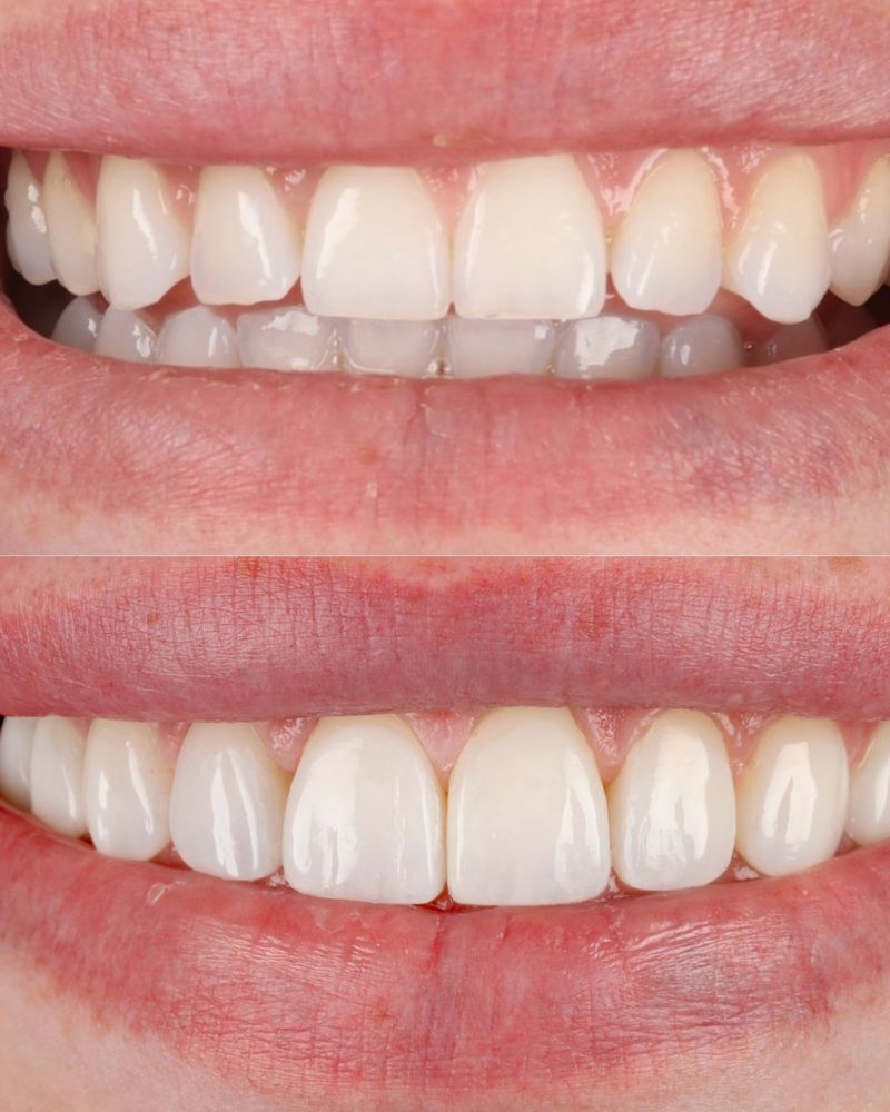 Queens Drive Dental Practice | Anthony O'keefe Before & after treatment with Anthony