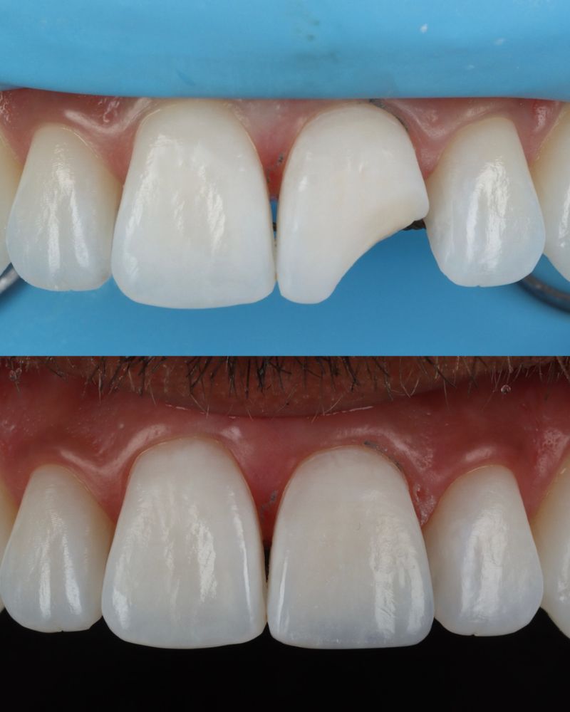 Queens Drive Dental Practice | Anthony O'keefe Before & after treatment with Anthony