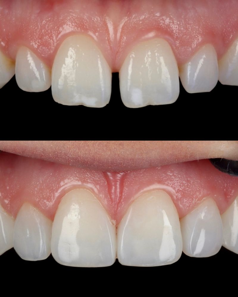 Queens Drive Dental Practice | Anthony O'keefe Before & after treatment with Anthony