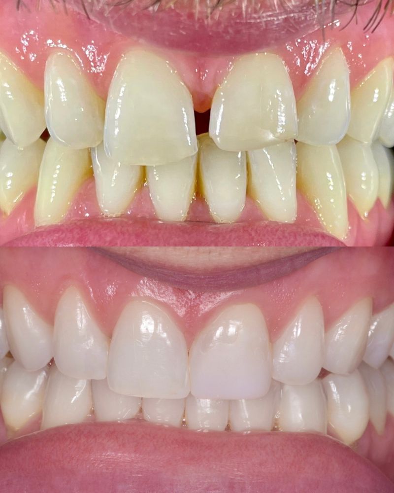 Queens Drive Dental Practice | John Paul Delaney Before & after treatment with John Paul