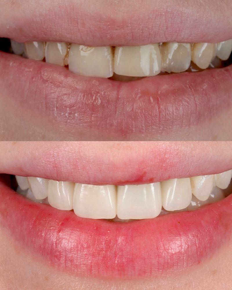 Queens Drive Dental Practice | Smile Makeovers Glasgow Before and after treatment at Queens Drive Dental