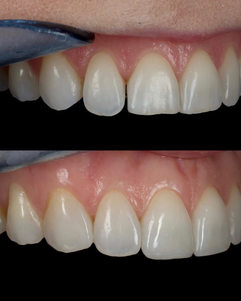 Queens Drive Dental Practice | Anthony O'keefe Before & after treatment with Anthony
