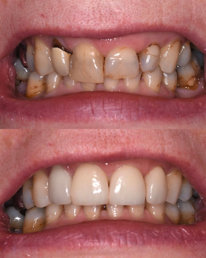 Queens Drive Dental Practice | John Paul Delaney Before & after treatment with John Paul