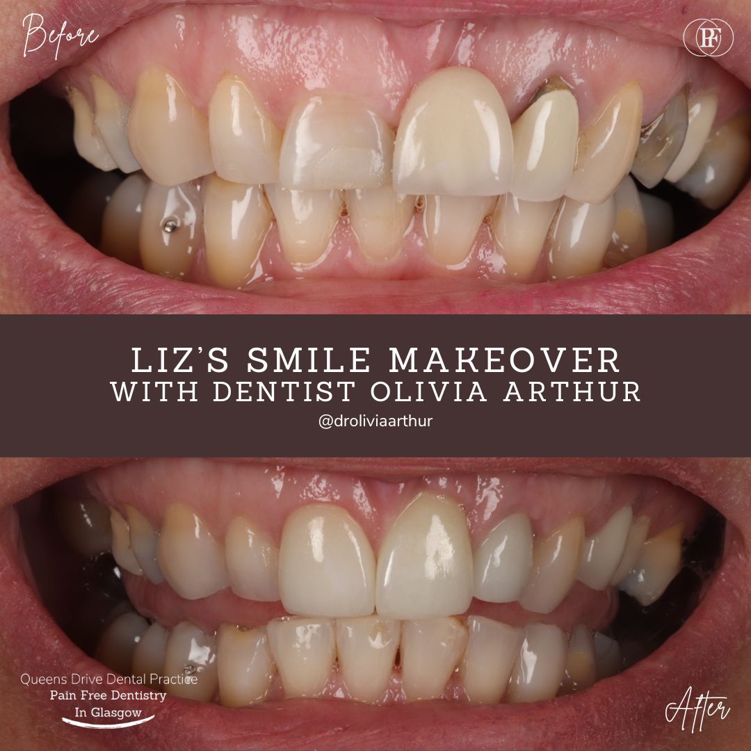 Smile makeover patient story at Queens Drive Glasgow