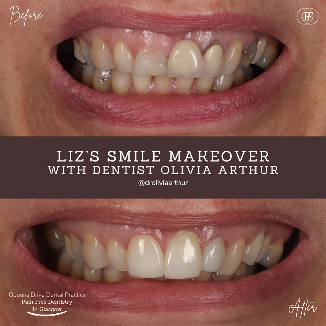 Queens Drive Dental Practice | Olivia Arthur Smile makeover patient story at Queens Drive Glasgow