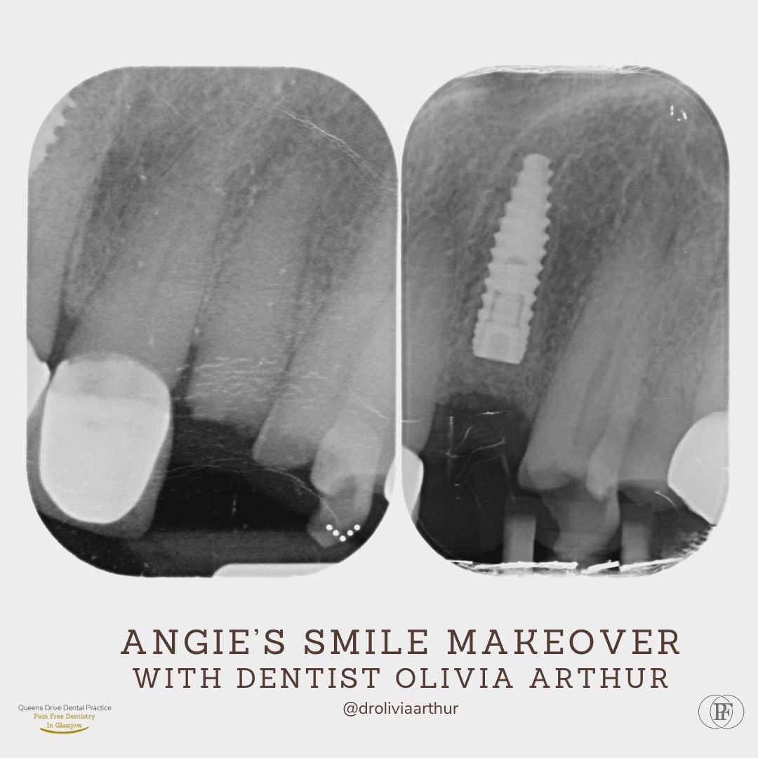 Queens Drive Dental Practice | Angie's Smile Story