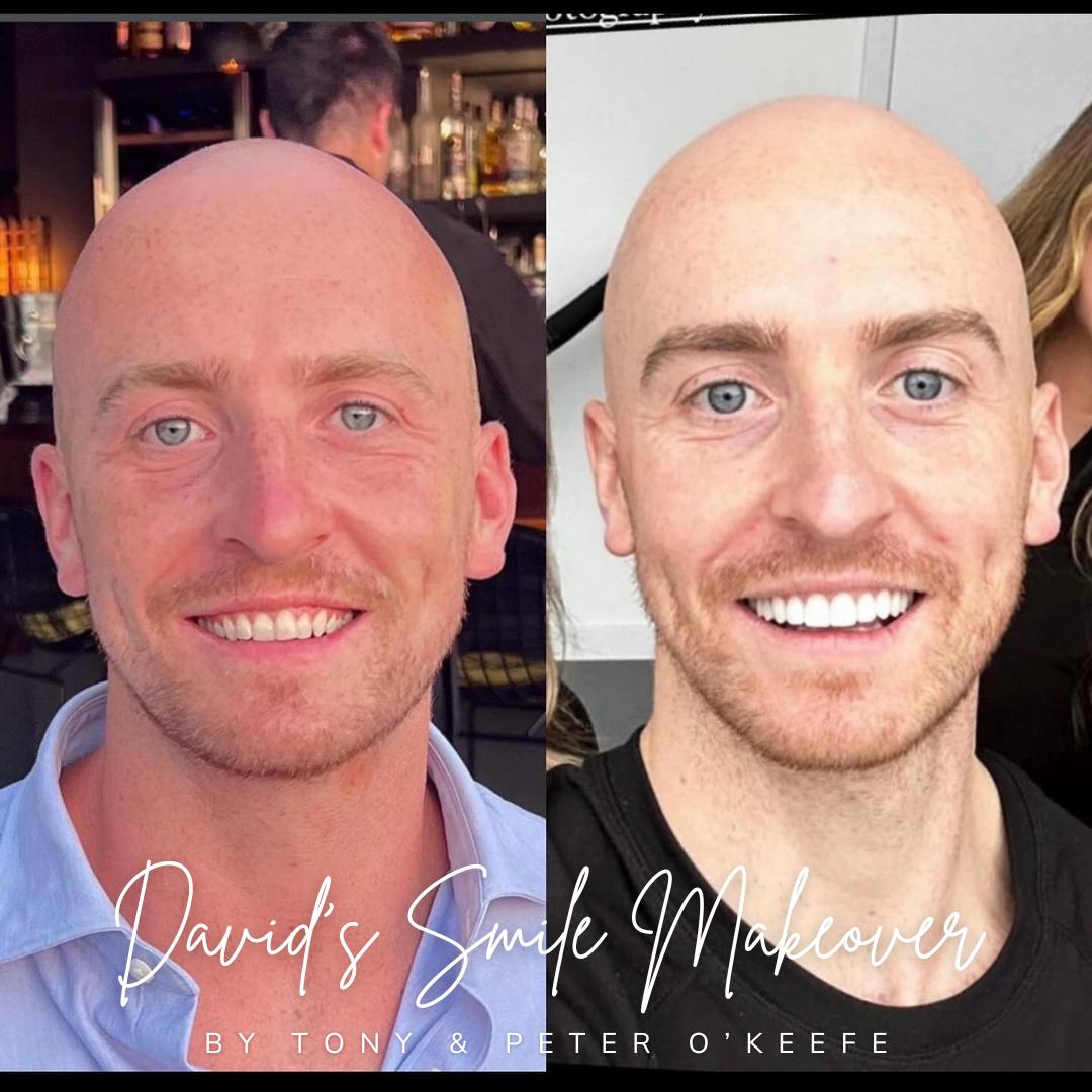 Queens Drive Dental Practice | Composite Bonding Before & After Composite Treatments at Queens Drive Dental Practice in Glasgow