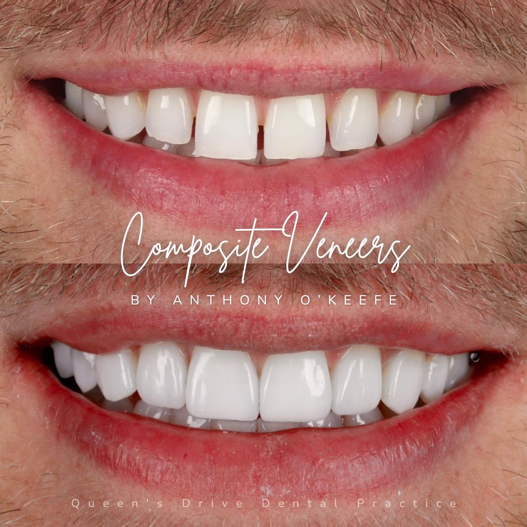 Queens Drive Dental Practice | Composite Bonding Before & After Composite Treatments