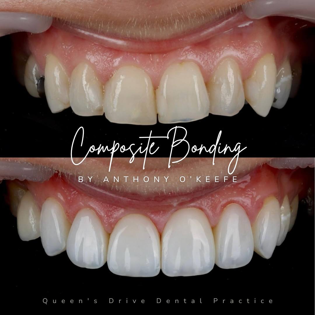 Queens Drive Dental Practice | Composite Bonding Before & After Composite Treatments
