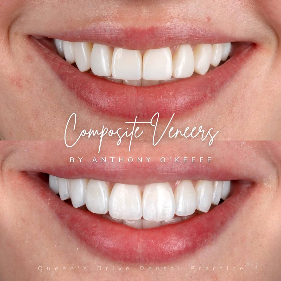 Queens Drive Dental Practice | Composite Bonding Before & After Composite Treatments