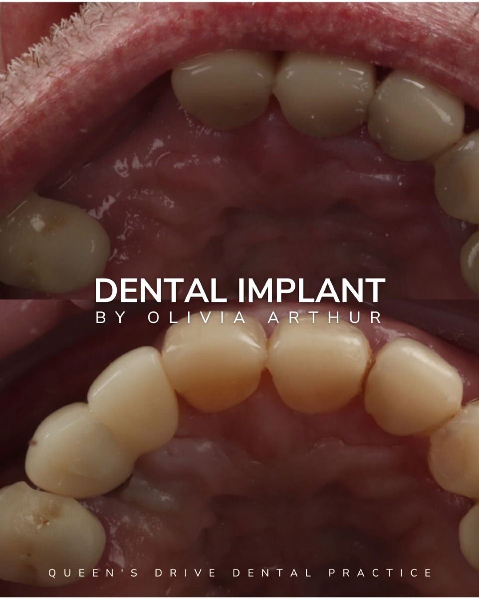 Before & After Dental Implant Treatment at Queens Drive in Glasgow