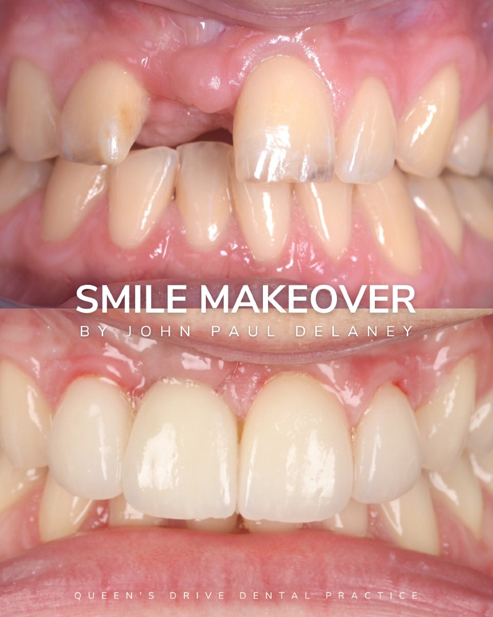 Before & After Dental Implant Treatment at Queens Drive in Glasgow