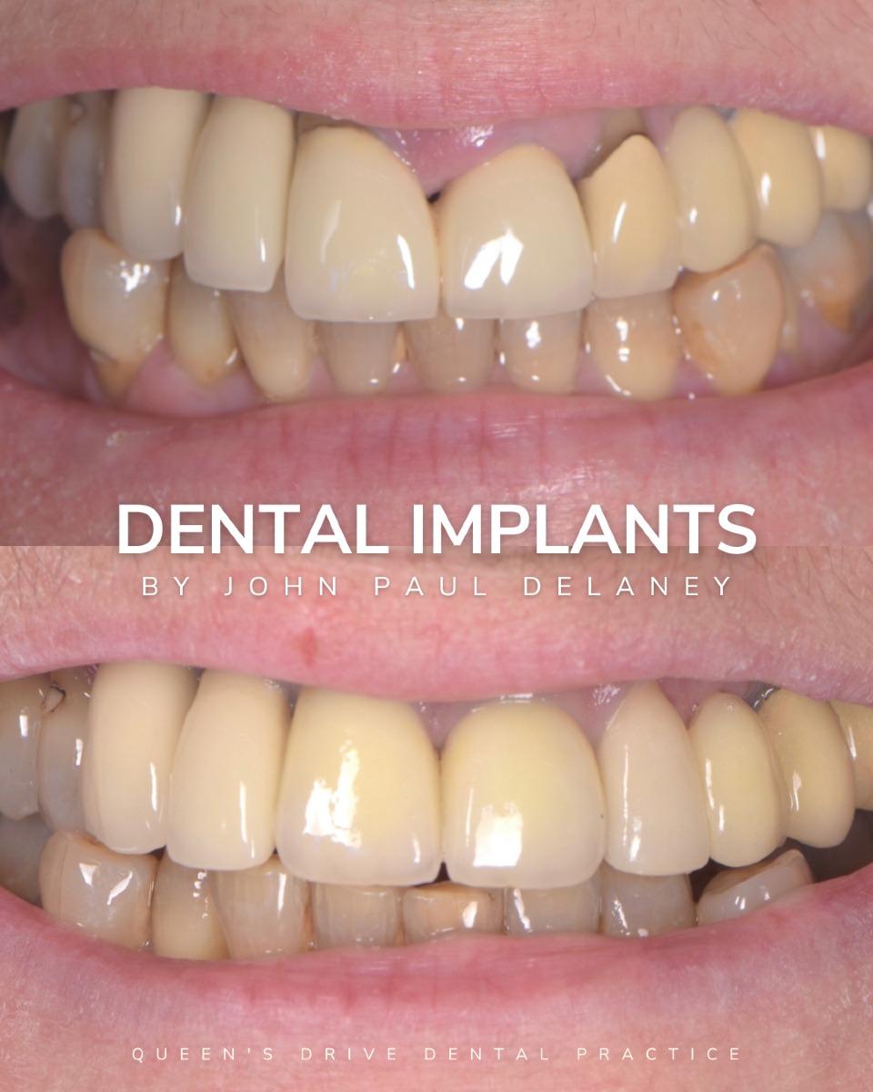 Before & After Dental Implant Treatment at Queens Drive in Glasgow