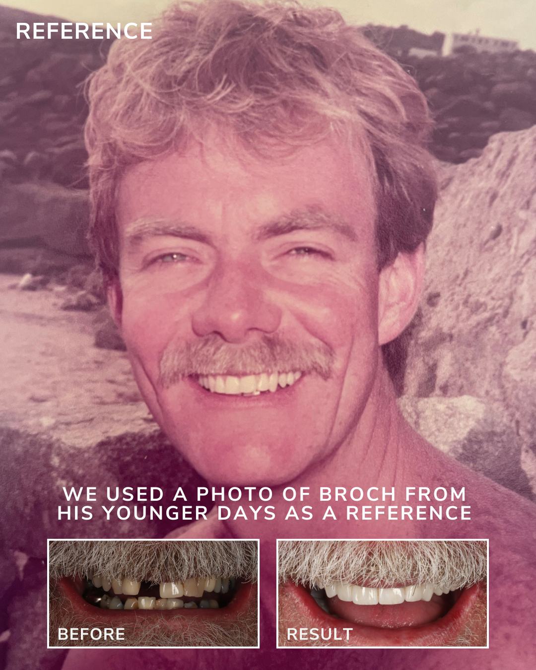 Before & After Dental Implant Treatment at Queens Drive in Glasgow