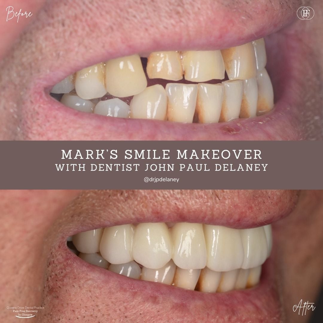 Queens Drive Dental Practice | Mark´s Smile Story