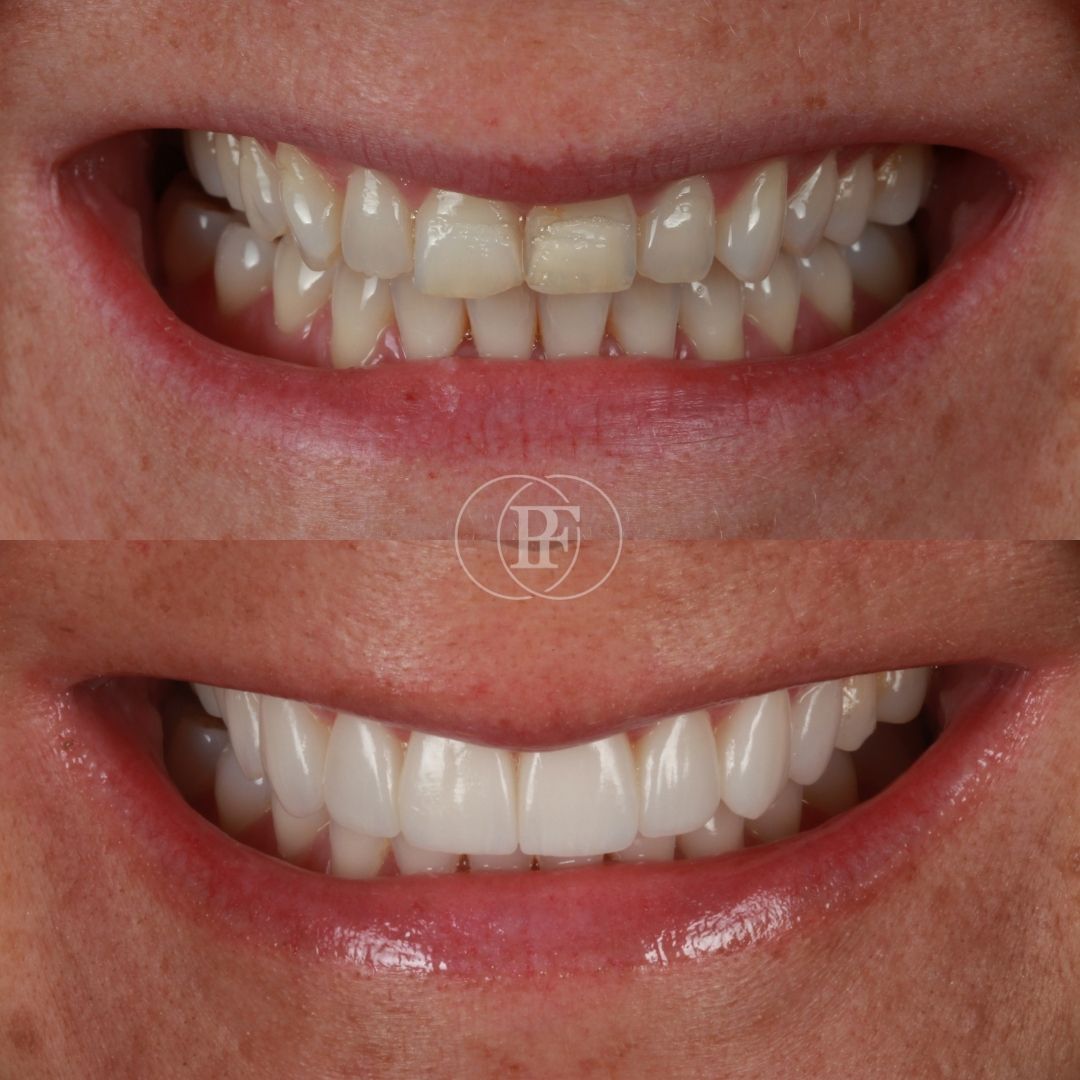 Before and after veneers