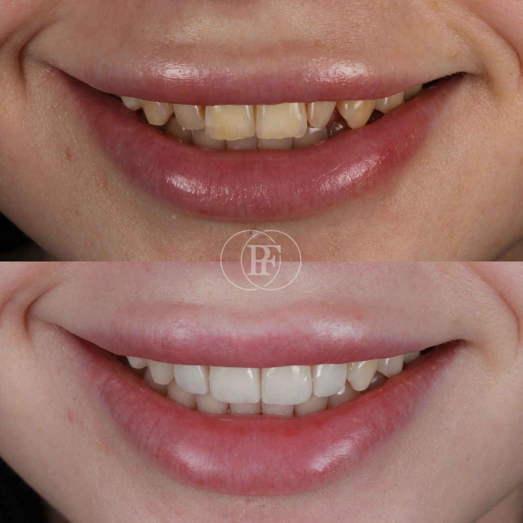 Before and after veneers