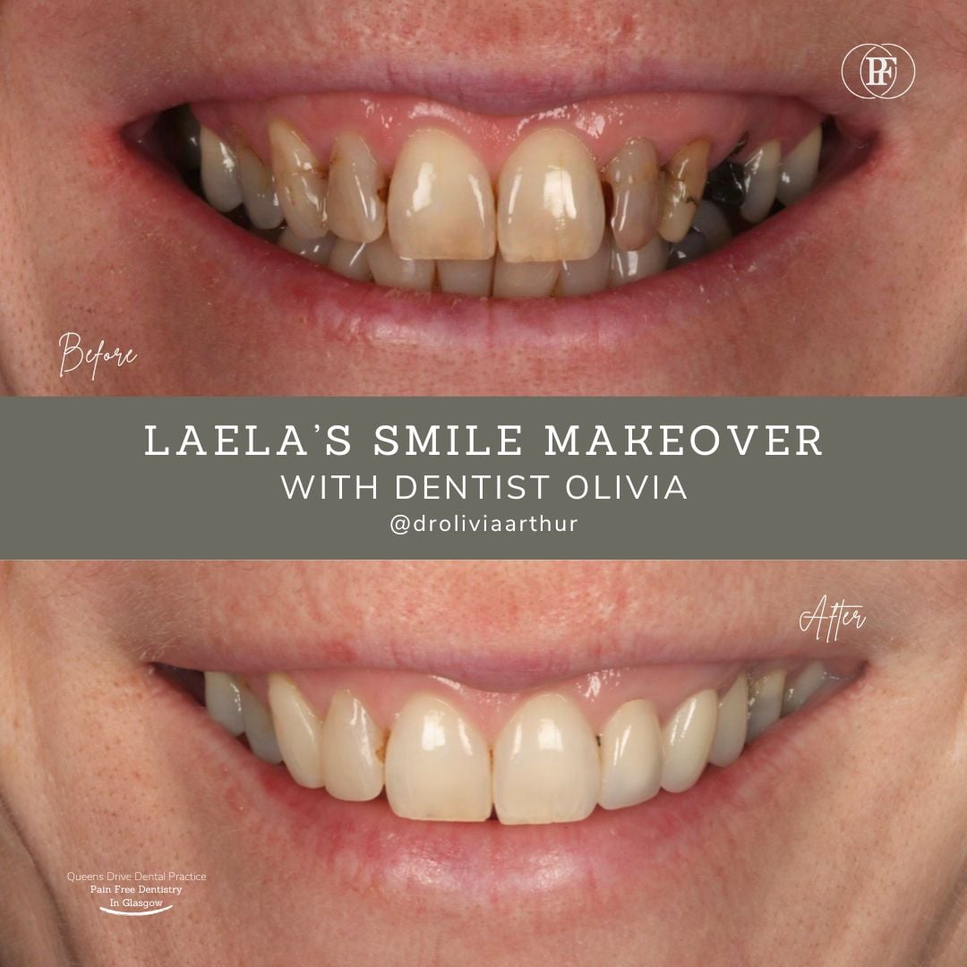 Queens Drive Dental Practice | Laela's Smile Story B A 5