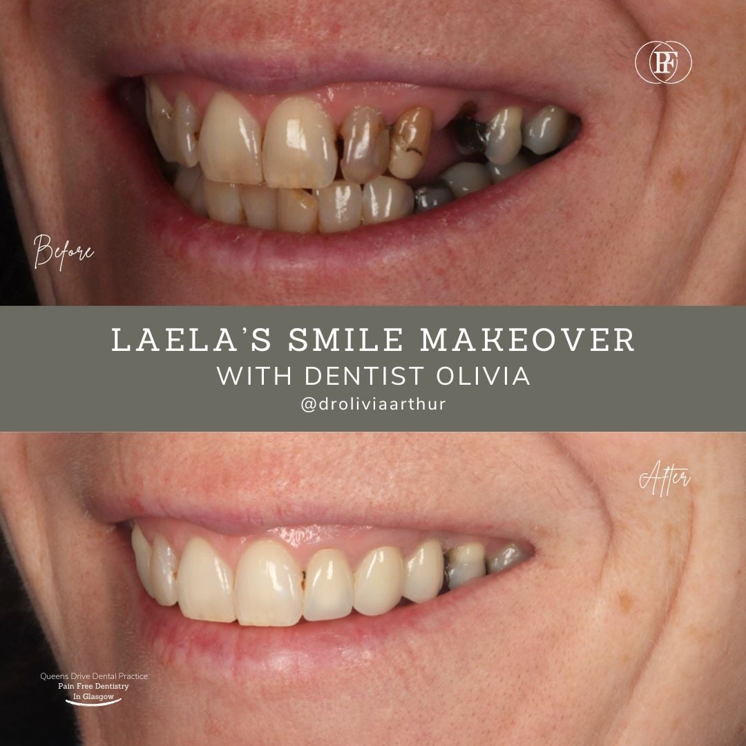 Queens Drive Dental Practice | Laela's Smile Story B A 6