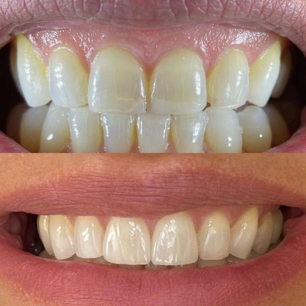 Queens Drive Dental Practice | Smile Gallery Before and after treatment at Queens Drive Dental in Glasgow