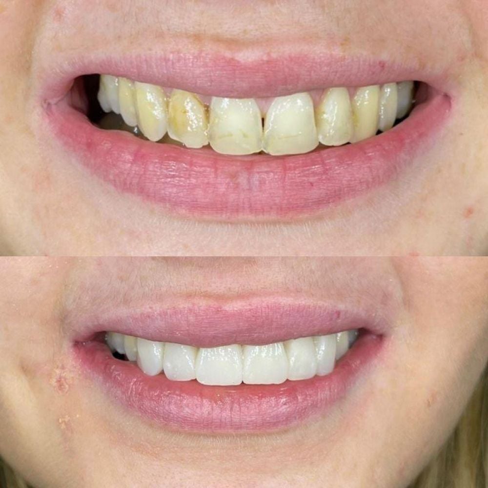 Queens Drive Dental Practice | Smile Gallery Before and after treatment at Queens Drive Dental in Glasgow