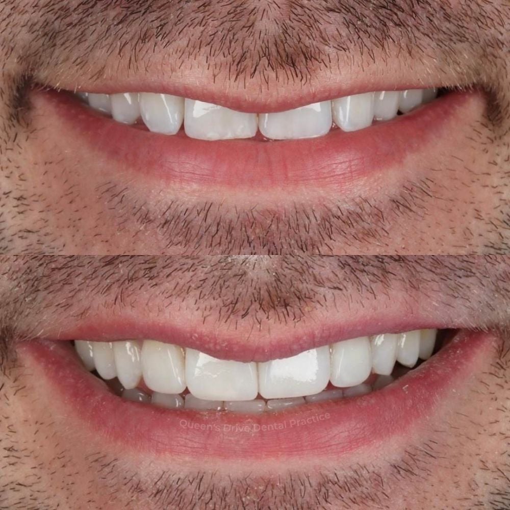 Queens Drive Dental Practice | Smile Gallery Before and after treatment at Queens Drive Dental in Glasgow