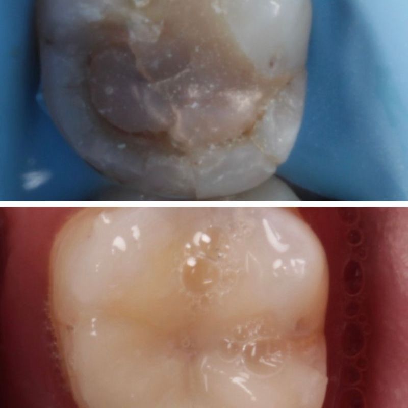 Queens Drive Dental Practice | Thurga Before & after treatment with Thurga