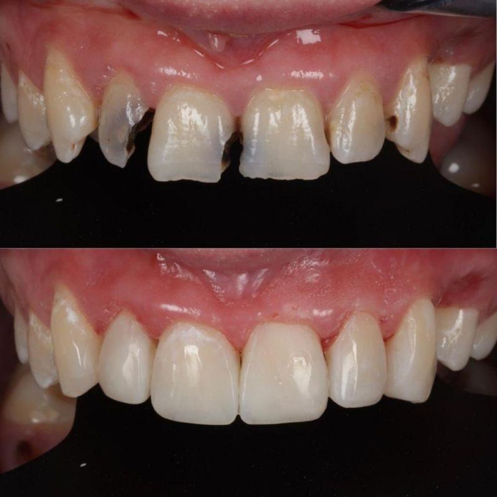 Queens Drive Dental Practice | Smile Gallery Before and after treatment at Queens Drive Dental in Glasgow