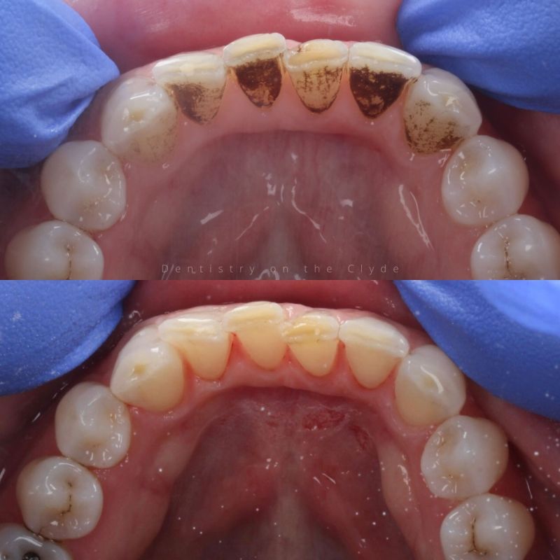Queens Drive Dental Practice | Thurga Before & after treatment with Thurga