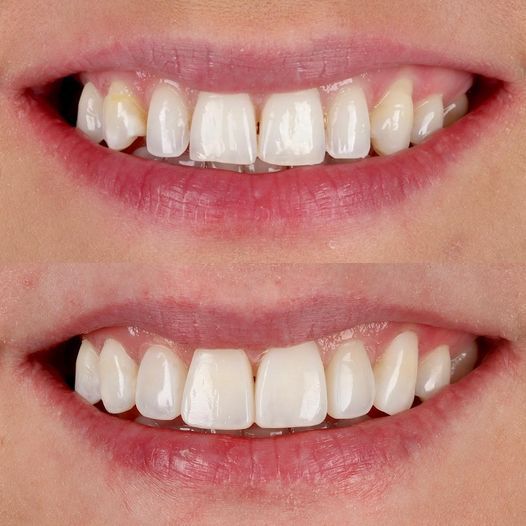 Queens Drive Dental Practice | Composite Bonding composite bonding