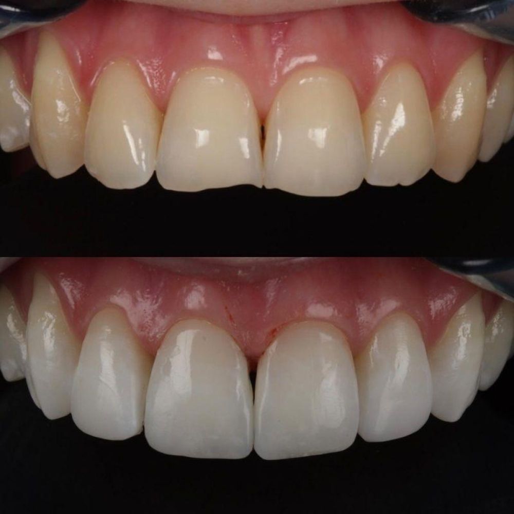 Queens Drive Dental Practice | Smile Gallery Before and after treatment at Queens Drive Dental in Glasgow