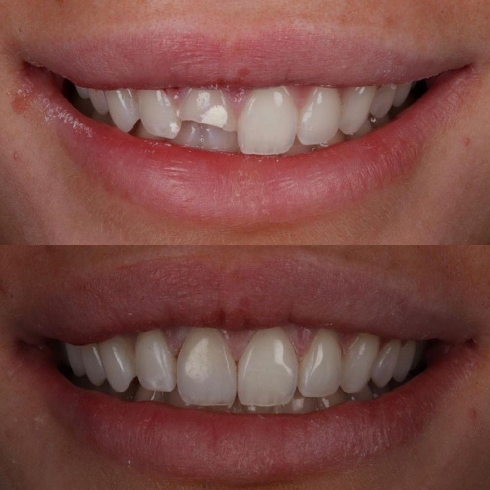 Queens Drive Dental Practice | Queens Drive Dental Practice, Glasgow Before and after treatment at Queens Drive Dental in Glasgow