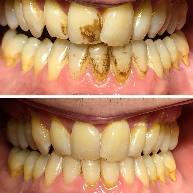 Queens Drive Dental Practice | Thurga Before & after treatment with Thurga