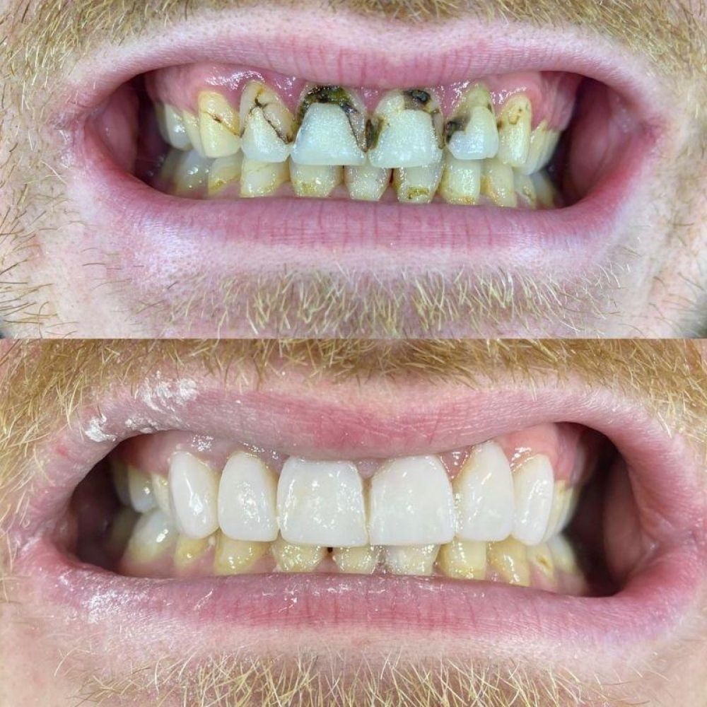 Queens Drive Dental Practice | Smile Gallery Before and after treatment at Queens Drive Dental in Glasgow