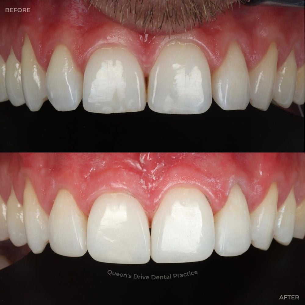Queens Drive Dental Practice | Queens Drive Dental Practice, Glasgow Before and after treatment at Queens Drive Dental in Glasgow